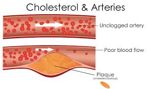 LDL Cholesterol And Erectile Dysfunction